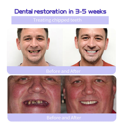 🎁Flash Sale - Don’t Miss Out - ODALIT™ TeethRestoration Mineral Powder🦷(CDA recommended)👩‍⚕️(Treats periodontitis and mouth ulcers, prevents tooth loss, and repairs gum recession)